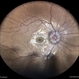 Disc Edema