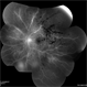 Behcet's Syndrome