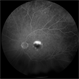 Fluorescein Angiogram of an RPE Rip Fluorescein Angiogram of an RPE Rip