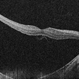 OCT in Subclinical RD in a Case of Retinitis Pigmentosa OCT in Subclinical RD in a Case of Retinitis Pigmentosa