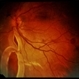 Retinal Detachment Retinal Detachment