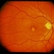 Adult Foveomacular Dystrophy / Pattern Adult Foveomacular Dystrophy / Pattern