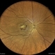 Subretinal Neovascular Membrane
