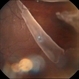 Traumatic Retinal Tear Traumatic Retinal Tear
