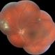 Ocular Toxoplasmosis Ocular Toxoplasmosis