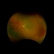 PDR with Peripheral NVEOS PDR with Peripheral NVEOS