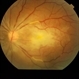 Central Retinal Artery Occlusion (CRAO) Central Retinal Artery Occlusion (CRAO)