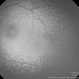 Lobular Choroidal Filling in ROP Stage 1 Lobular Choroidal Filling in ROP Stage 1