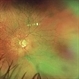 Retinal Detachment