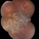 Total Rhegmatogenous Retinal Detachment With Severe PVR