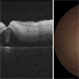 Macular OCT  Image of a Patient With Central Retinal Artery Occlusion