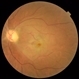 Branch Retinal Vein Occlusion