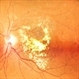 Circinate Mark at the Macula — a Lasting Trace of Branch Retinal Vein Occlusion Circinate Mark at the Macula — a Lasting Trace of Branch Retinal Vein Occlusion