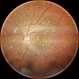 Retinal Arteriolar Variation Retinal Arteriolar Variation