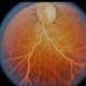 Hyperlipidemia