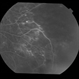Adult Coats' Disease