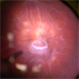 Total Retinal Detachment and Dislocated PCIOL Total Retinal Detachment and Dislocated PCIOL