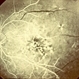 Primary Hyperoxaluria and Oxalosis