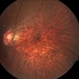 Bruch’s membrane rupture Bruch’s membrane rupture