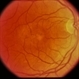 Juxtafoveal Telangiectasis / DM / Diabetes