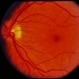 Optic Nerve Meningioma Optic Nerve Meningioma