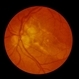 Peculiar Acute Subretinal Fibrosis Peculiar Acute Subretinal Fibrosis