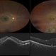 Traumatic Macular Hole pre and post repair Traumatic Macular Hole pre and post repair