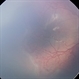 Aggressive Posterior Retinopathy of Prematurity (APROP)