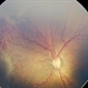 Stage 4A Retinopathy of Prematurity Stage 4A Retinopathy of Prematurity