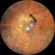 Proliferative Diabetic Retinopathy Proliferative Diabetic Retinopathy