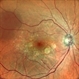 HEREDITARY MACULAR DEGENERATION WITH ETHAMBUTOL TOXICITY HEREDITARY MACULAR DEGENERATION WITH ETHAMBUTOL TOXICITY
