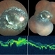 Chorioretinitis Sclopetaria Chorioretinitis Sclopetaria
