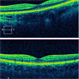 Laser Pointer Injury to Fovea.  Normal Fellow Eye for Comparison. Laser Pointer Injury to Fovea.  Normal Fellow Eye for Comparison.