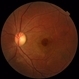 Traumatic Macular Hole and Choroidal Ruptures Traumatic Macular Hole and Choroidal Ruptures