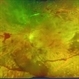 Cataract, Tractional Retinal Detachment, Vitreous Hemorrhage