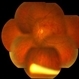 BRVO With Ozurdex Implant in Vitreous BRVO With Ozurdex Implant in Vitreous