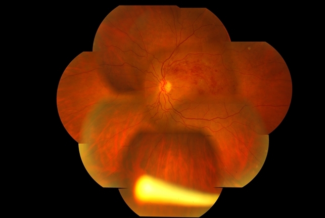 BRVO With Ozurdex Implant in Vitreous - Retina Image Bank