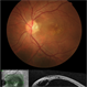 Optic Pit Maculopathy Optic Pit Maculopathy