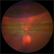 Retinal Detachment with PVR Retinal Detachment with PVR