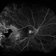 Exudative  Retinal Detachment, Secondary to Coat's Disease Exudative  Retinal Detachment, Secondary to Coat's Disease