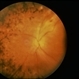 Necrotizing Retinitis Necrotizing Retinitis
