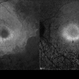Case 2 Retinitis Pigmentosa BAF IRAF OS Case 2 Retinitis Pigmentosa BAF IRAF OS