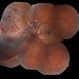 Retinitis Sclopetaria Retinitis Sclopetaria