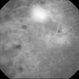 Neovascularization - RDP