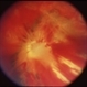 Double Perforating Injury