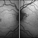 Macular Telangiectasia type 2 Macular Telangiectasia type 2