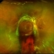Diabetic Tractional Retinal Detachment Diabetic Tractional Retinal Detachment