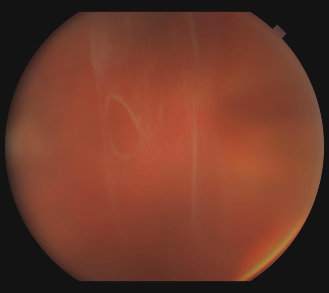 Evaluation And Management Of Pvd