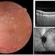 Hypertensive Choroidopathy - Left Eye