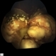 Retinoblastoma